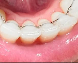 Customer photo 2 shared with a review of Dentart™ Deep Cleansing Tooth Powder, Feb 27, 2026